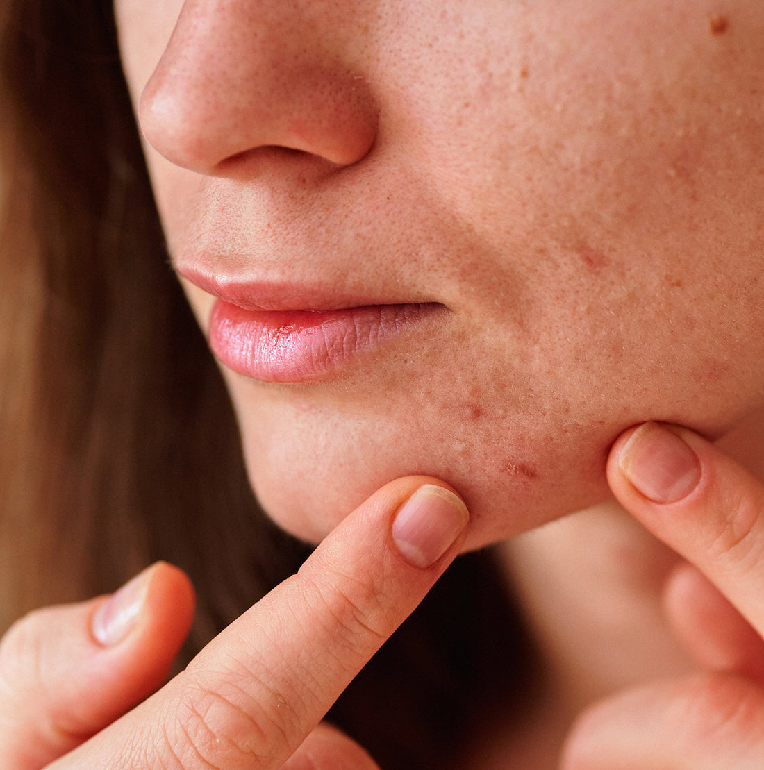 How Mental Health Affects Your Skin – A Traditional Persian Medicine Perspective